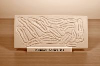 Prosthetic mould Keloid Scars 01